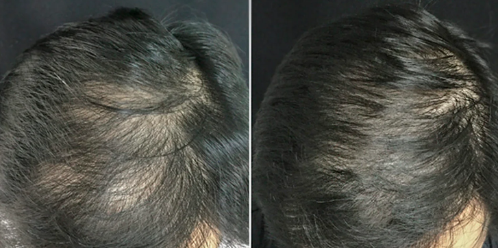 PRP for hair restoration